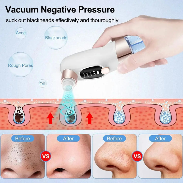 GlowVac Pro – Removedor de Cravos Elétricos, Aspirador de Poros e Pontos Pretos para uma Pele Livre de Espinhas e Acne ROSLIN'SHOP Seu Estilo Nossa Força